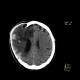 Cerebral ischemia, craniotomy, subarachnoid hemorrhage: CT - Computed tomography